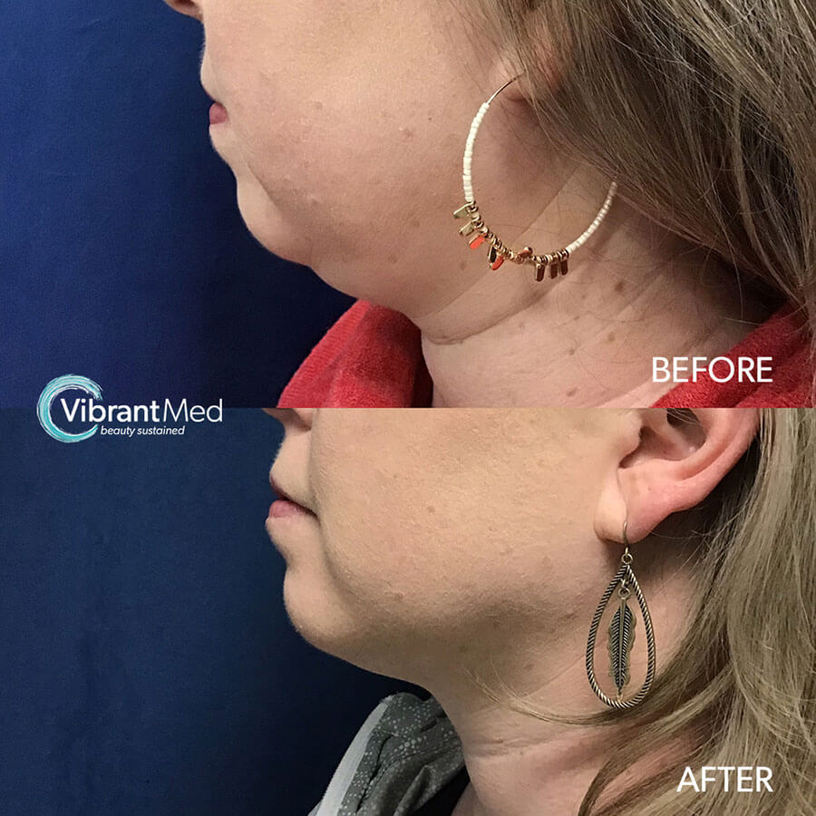 Chin CoolSculpting Side Before and After