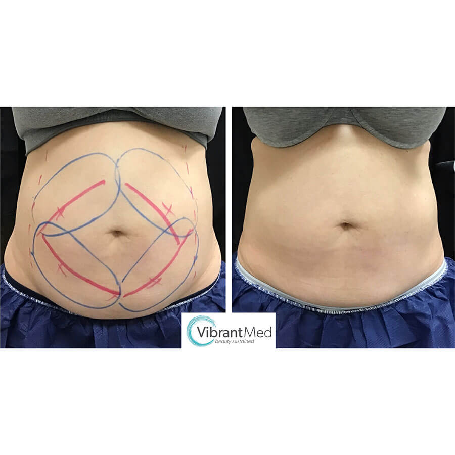 CoolSculpting Abs Before and After
