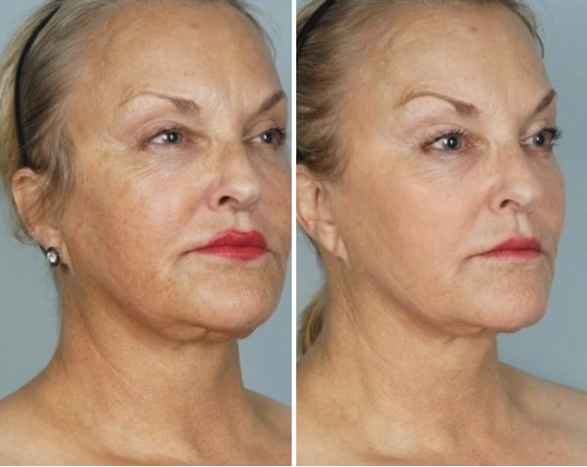 Tetra CoolPeel Before and After